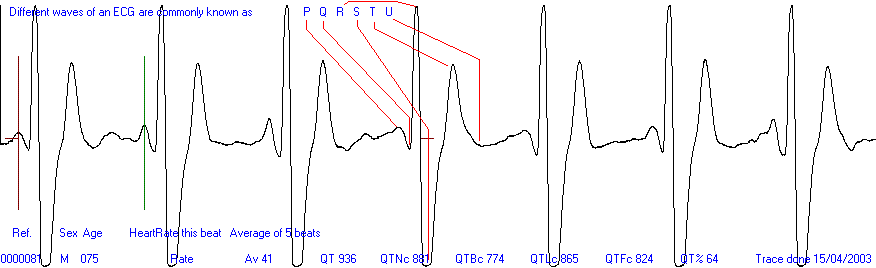 Easy ECG heart trace
